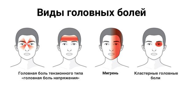 lokalizaciya razlichnyh vidov golovnoy boli s