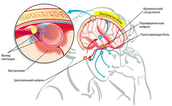 svyaz peptidov i migreni s